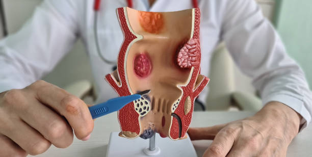 anal fistula surgery in Dubai