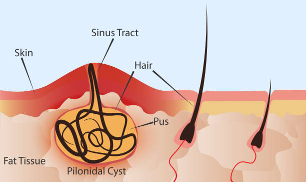 Pilonidal Sinus Surgery in Dubai