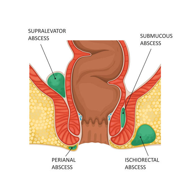 anal fistula surgery in Dubai